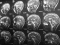 Czy rezonans magnetyczny wykrywa schizofrenię? Seria przekrojów mózgu na obrazach MRI pokazuje jego strukturę, ale nie diagnozuje schizofrenii.