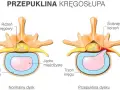 Jakie leki na przepuklinę lędźwiową mogą złagodzić Twój ból?