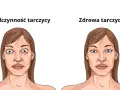 Nadczynność tarczycy objawy psychiczne - jak je rozpoznać i leczyć