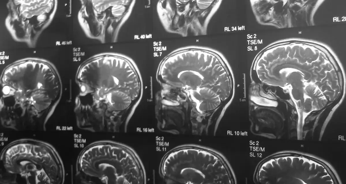 Czy rezonans magnetyczny wykrywa schizofrenię? Seria przekrojów mózgu na obrazach MRI pokazuje jego strukturę, ale nie diagnozuje schizofrenii.