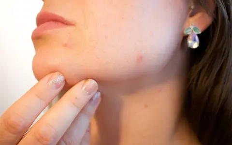 Krosta na brodzie i kilka innych na policzku to sygnał, jak rozpoznać zaburzenia hormonalne.