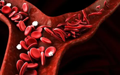 Naczynia krwionośne z prawidłowym i sierpowatym kształtem erytrocytów. Czy anemia może być ze stresu?