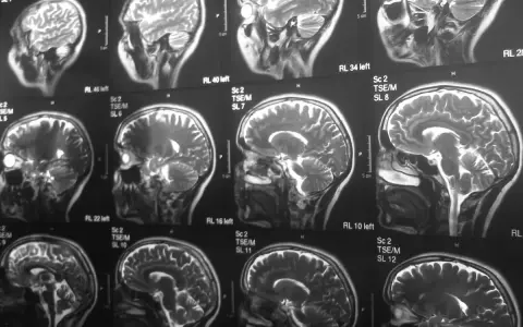 Czy rezonans magnetyczny wykrywa schizofrenię? Seria przekrojów mózgu na obrazach MRI pokazuje jego strukturę, ale nie diagnozuje schizofrenii.
