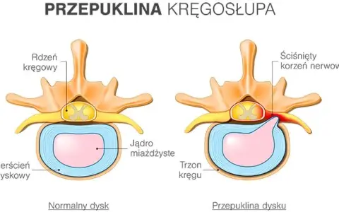 Jakie leki na przepuklinę lędźwiową mogą złagodzić Twój ból?