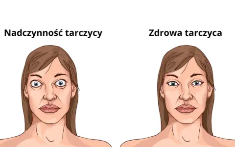 Nadczynność tarczycy objawy psychiczne - jak je rozpoznać i leczyć