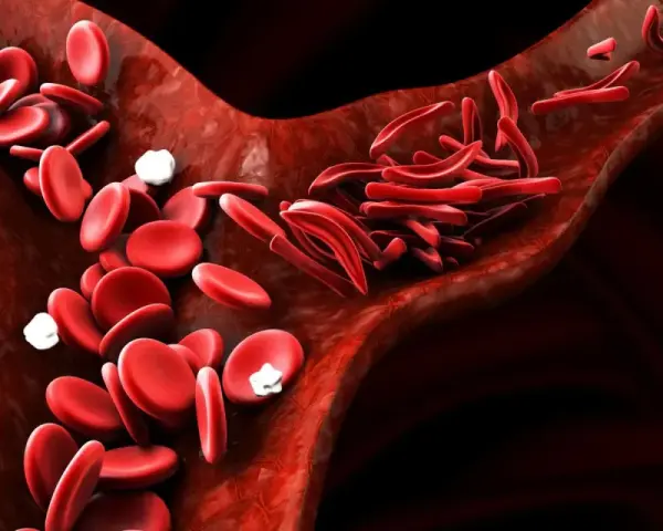 Naczynia krwionośne z prawidłowym i sierpowatym kształtem erytrocytów. Czy anemia może być ze stresu?