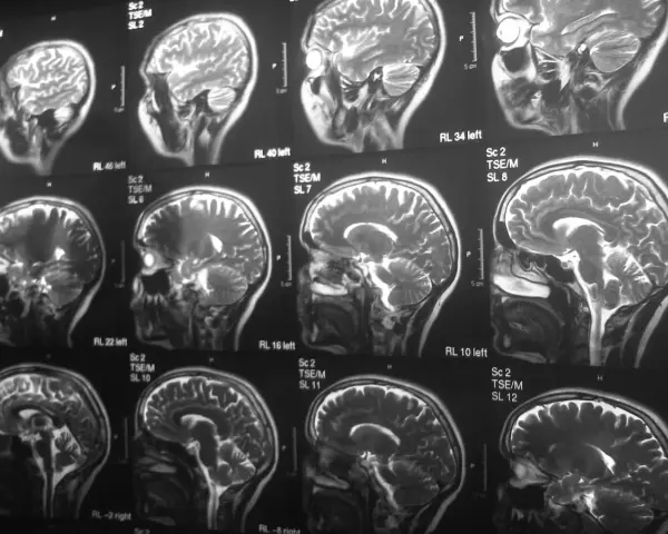 Czy rezonans magnetyczny wykrywa schizofrenię? Seria przekrojów mózgu na obrazach MRI pokazuje jego strukturę, ale nie diagnozuje schizofrenii.