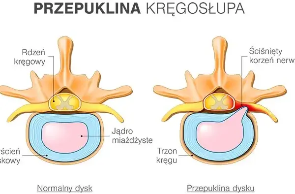 Jakie leki na przepuklinę lędźwiową mogą złagodzić Twój ból?