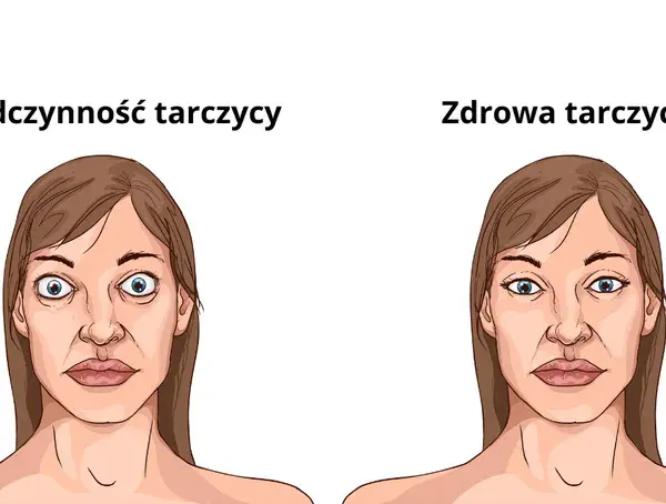 Nadczynność tarczycy objawy psychiczne - jak je rozpoznać i leczyć