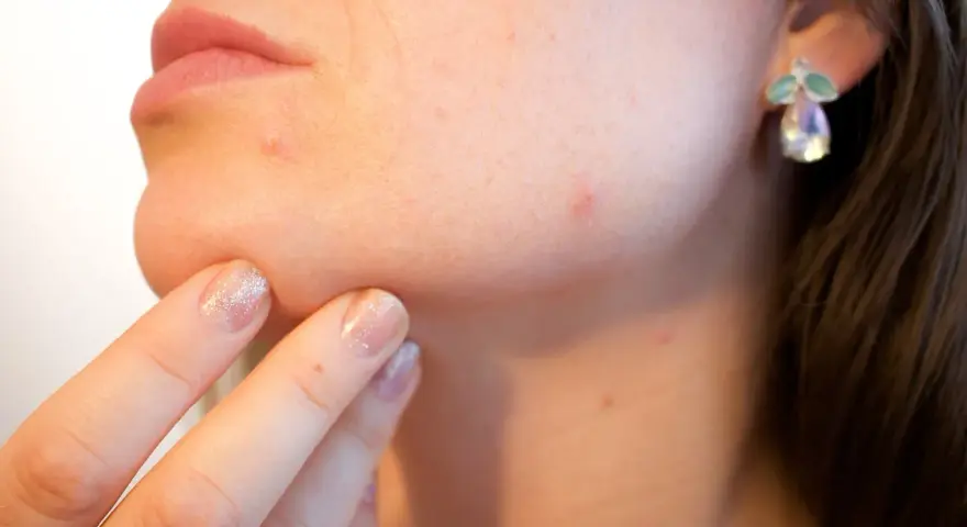 Krosta na brodzie i kilka innych na policzku to sygnał, jak rozpoznać zaburzenia hormonalne.