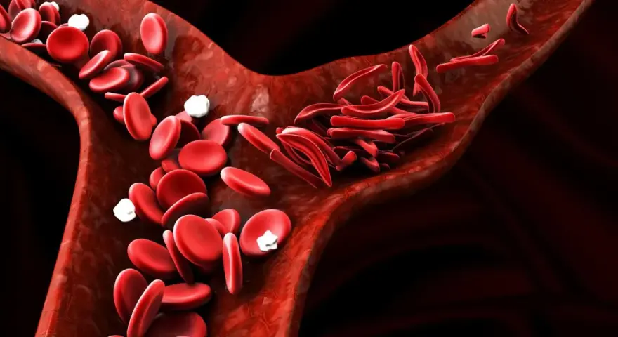 Naczynia krwionośne z prawidłowym i sierpowatym kształtem erytrocytów. Czy anemia może być ze stresu?
