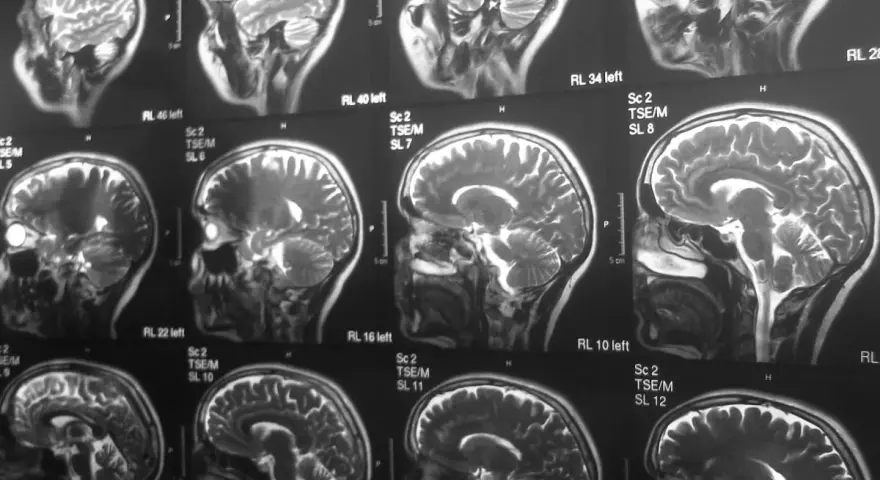 Czy rezonans magnetyczny wykrywa schizofrenię? Seria przekrojów mózgu na obrazach MRI pokazuje jego strukturę, ale nie diagnozuje schizofrenii.
