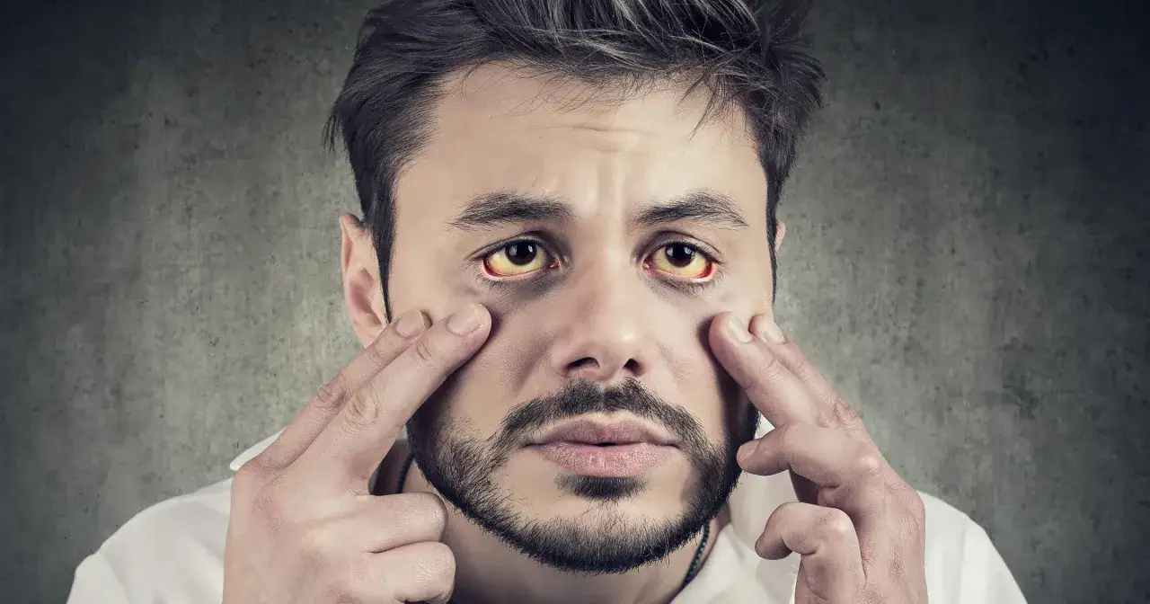 Zdjęcie Zespół Gilberta: Niezauważane objawy psychiczne, które mogą zaskakiwać